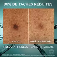 Comparaison avant/apres en gros plan sur une tache pigmentaire, avec le message « 86 % de taches reduites », sans retouche.