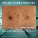 Comparaison avant/apres en gros plan sur une tache pigmentaire, avec le message « 86 % de taches reduites », sans retouche.