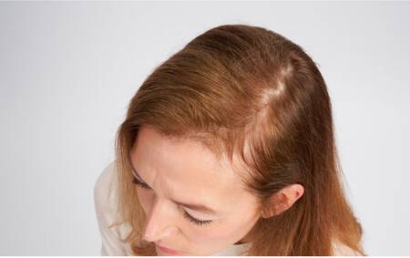 Perte de cheveux femme